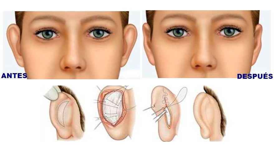 otoplastia