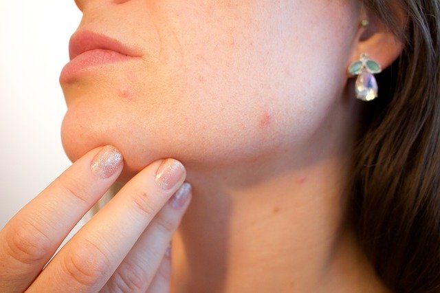 combatir el acné