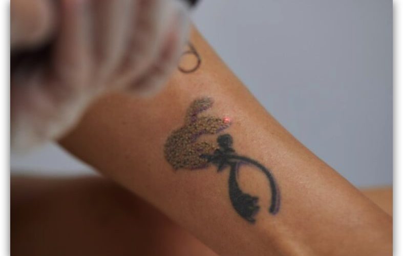 Eliminación de tatuajes centros especializados