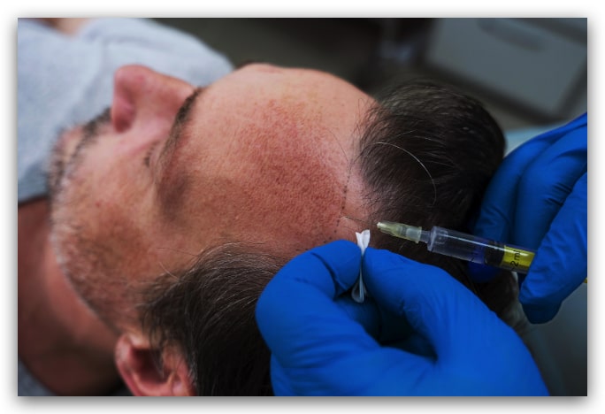 injerto capilar hecho con profesionales