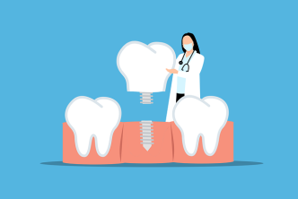 implantes dentales