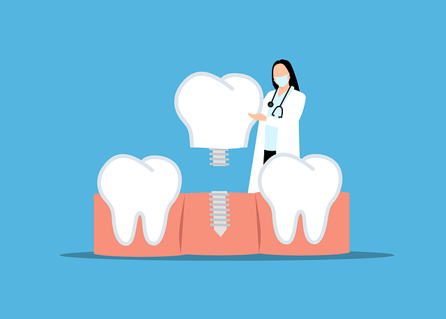 implantes dentales
