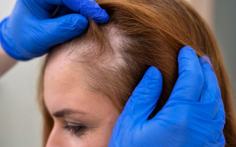 alopecia opciones revertir efectos