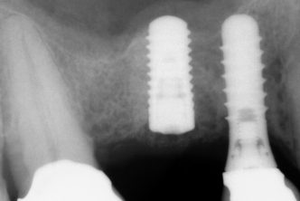 implantes dentales